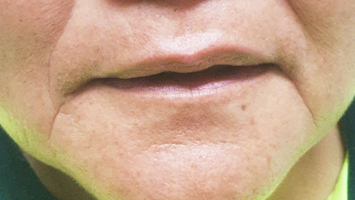 BPS dentures enhancement of lip support before